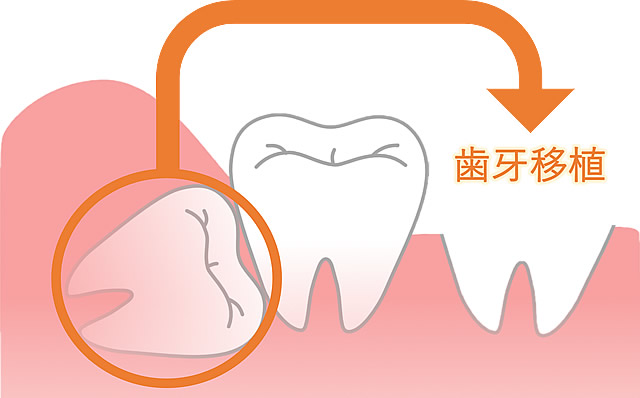 歯牙移植