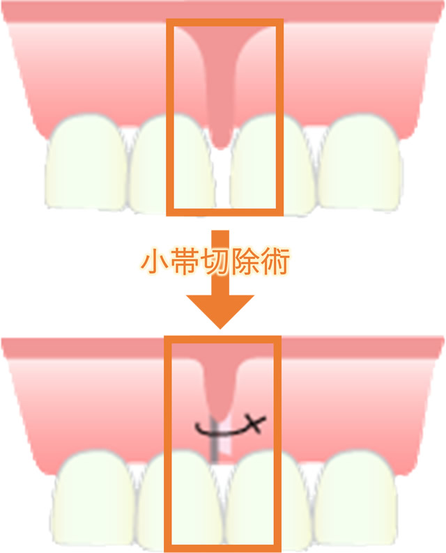 歯牙移植