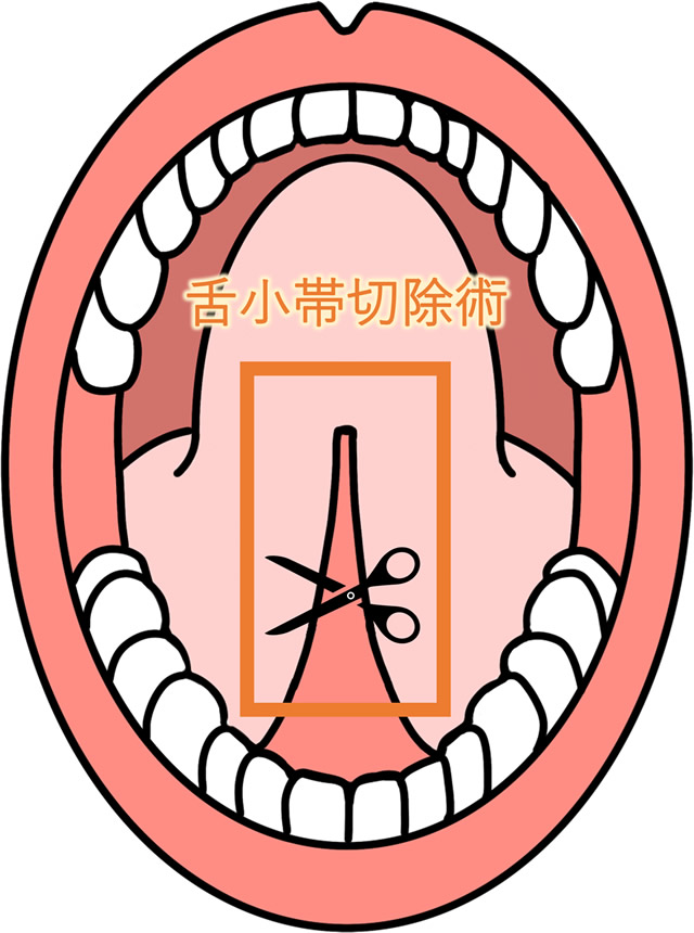 舌小帯切除術
